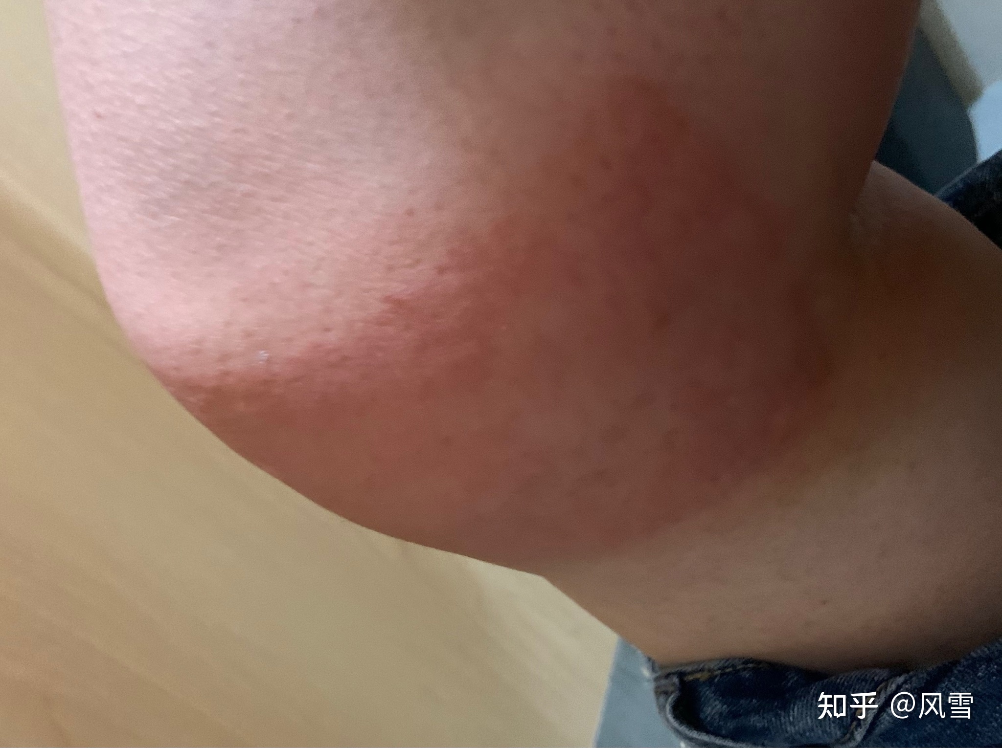 1、貼膏藥過敏癢紅腫怎么辦？
